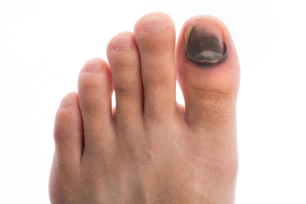 a bloody toenail in need of treatment