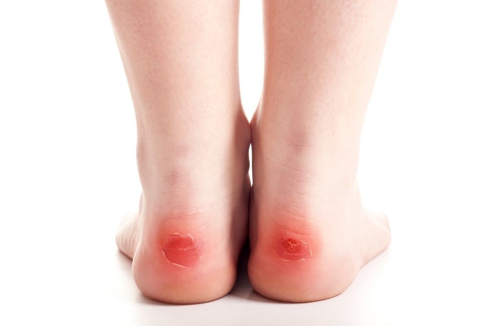 a person has blisters on the feet
