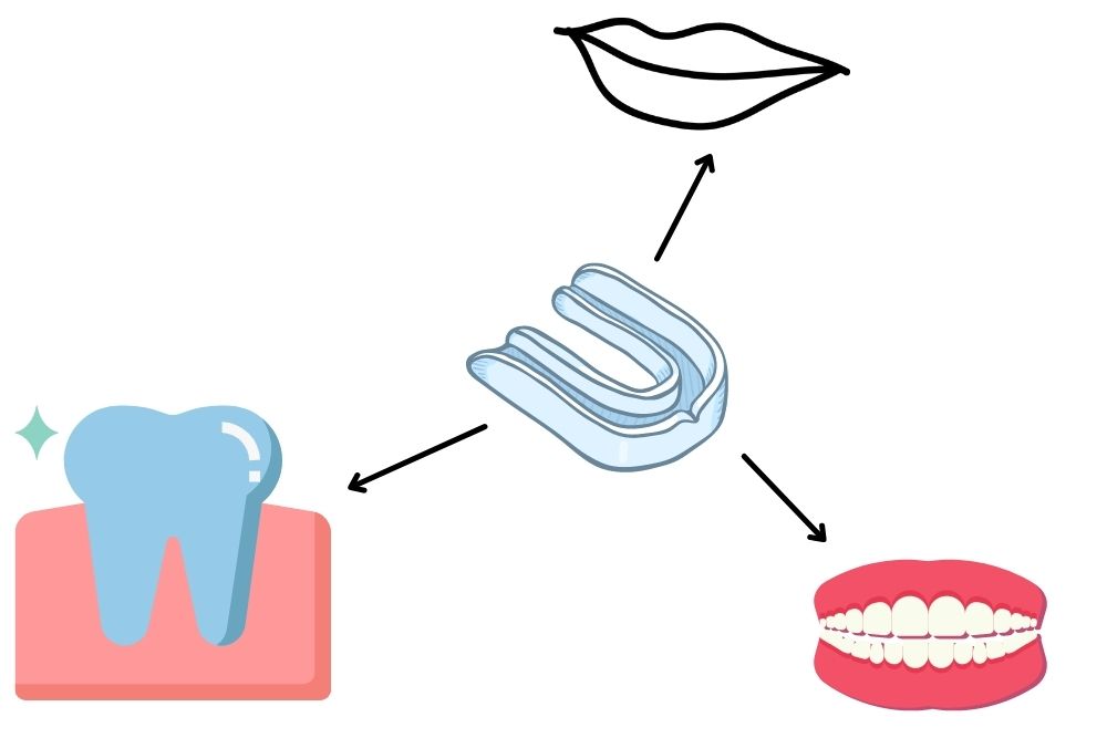 the protective effect of mouthguard