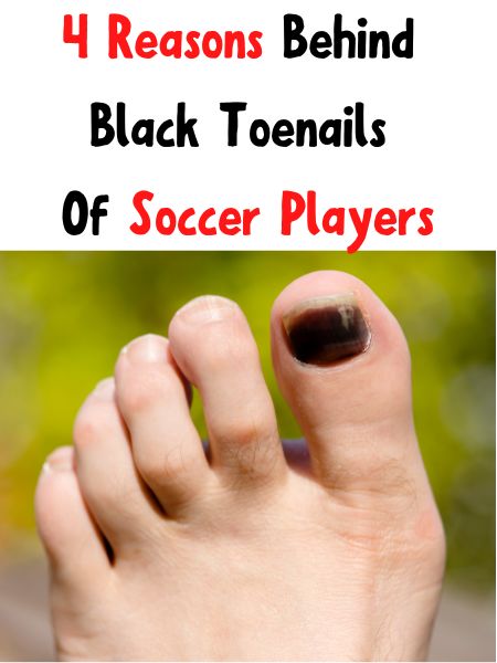 Black toenail and the title